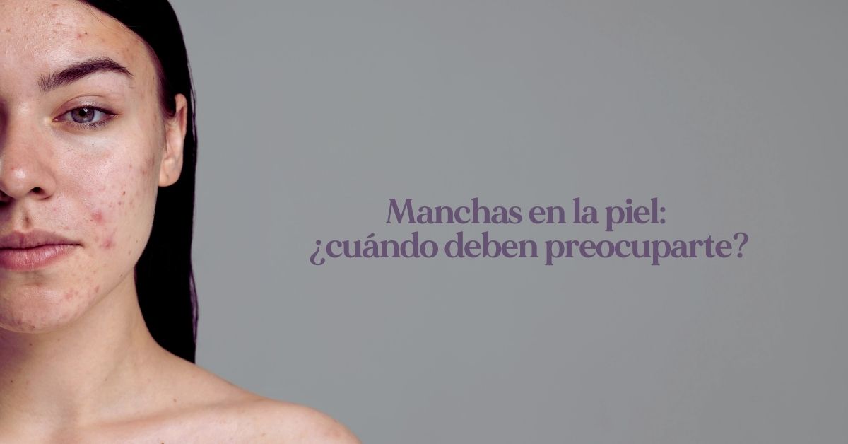 Manchas en la piel